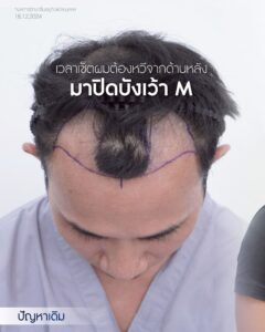 Medical-grade DHI hair transplant performed under specialist supervision
