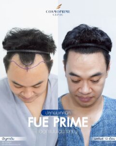 Male patient undergoing FUE hair transplant