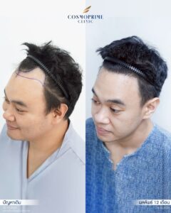Follicular unit extraction (FUE)