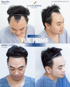Before and after results of DHI hair transplant