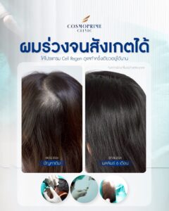 Non-surgical Cell Regen hair treatment designed to improve scalp condition and hair quality