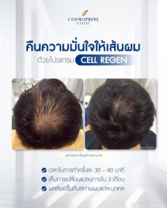 Cell Regen therapy for hair thinning focusing on scalp regeneration and follicle support