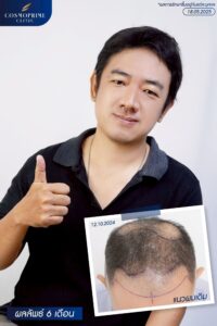 Before and after crown hair transplant showing improved density