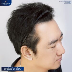 after hair transplant showing improved density