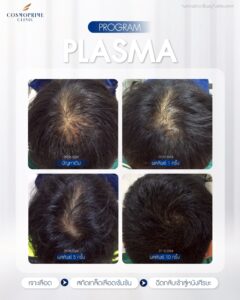 Cell Regen therapy for hair thinning focusing on scalp regeneration and follicle support