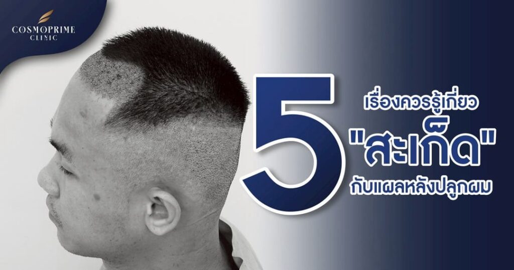 สะเก็ดแผลหลังปลูกผม