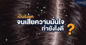รังแค-02