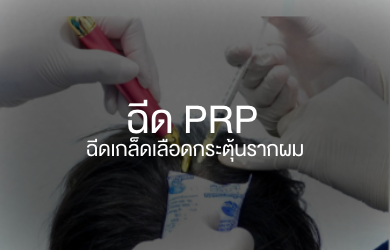 ฉีดเกล็ดเลือด PRP