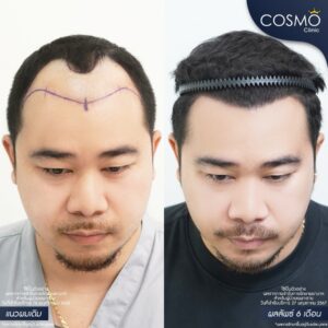 ปลูกผม