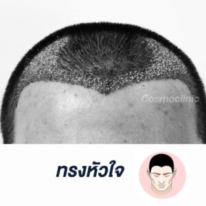 hairline