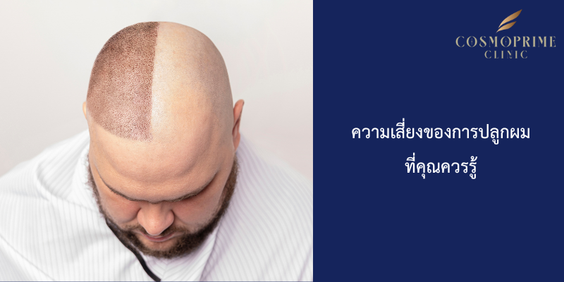 ความเสี่ยงของการปลูกผมที่คุณควรรู้