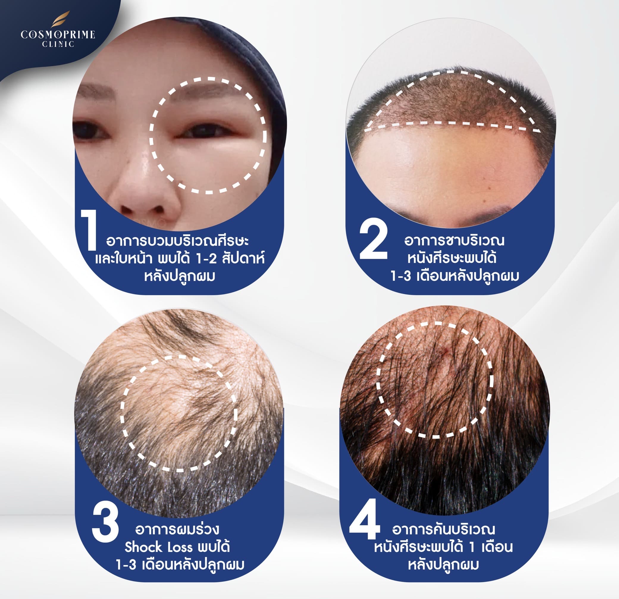 บวมหลังปลูกผม