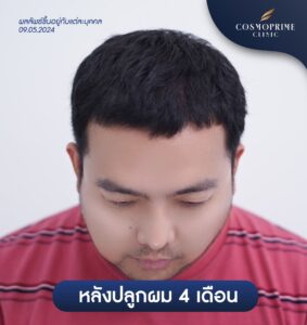 แผลปลูกผม