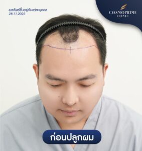 ข้อห้ามหลังปลูกผม