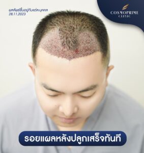 ปลูกผมกี่วัน รากติด