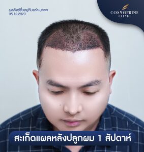 ผมร่วงหลังปลูกผม