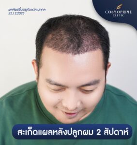 หลังปลูกผม 1 เดือน