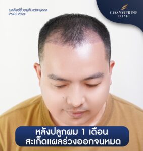 หลังปลูกผม 14 วัน
