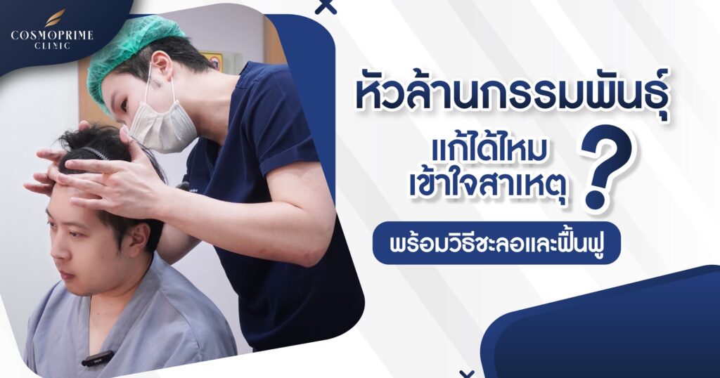 หัวล้านกรรมพันธุ์