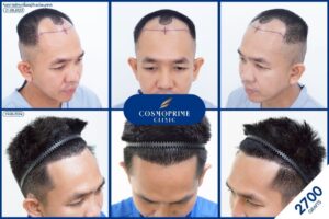 ก่อนหลังปลูกผม CosmoPrime Clinic Bangkok