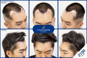 กิน ยา ปลูก ผม มี ลูก ได้ ไหม