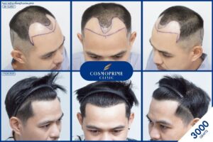 ปลูกผม ได้ผลจริง