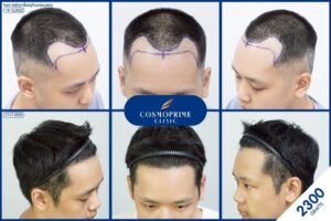 ยาปลูกผม ได้ผลจริง