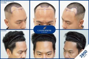 ยาปลูกผม ยี่ห้อไหนดี