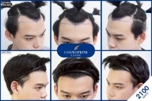 ยาปลูกผม