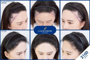 ปลูกผมราคาเท่าไหร่