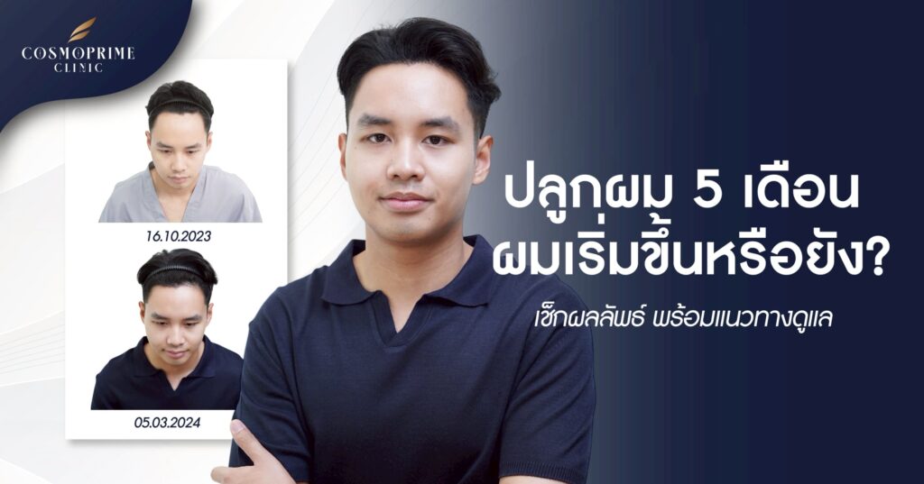 ปลูกผม 5 เดือน