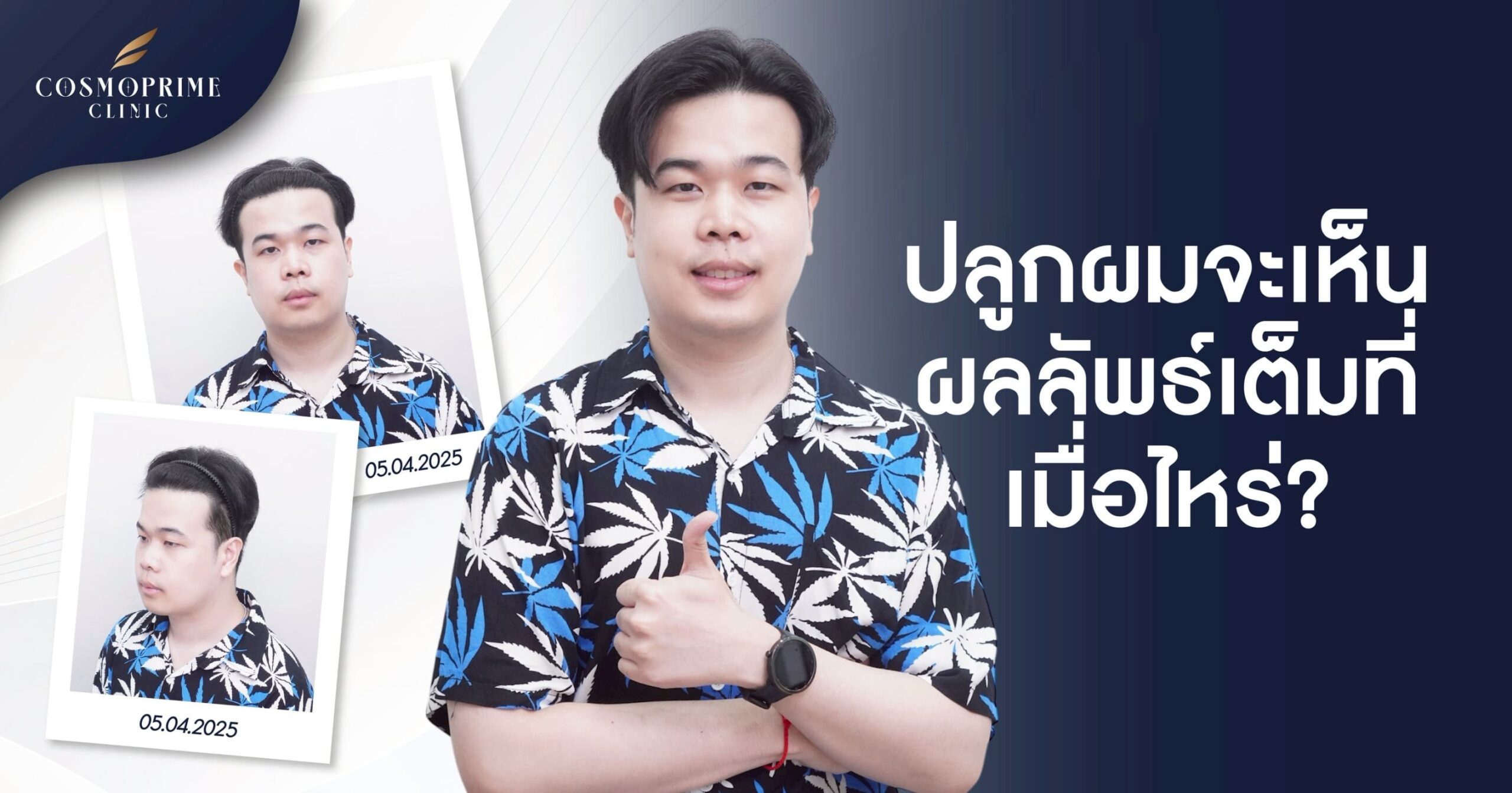 ปลูกผมจะเห็นผลลัพธ์เต็มที่เมื่อไหร่ ?