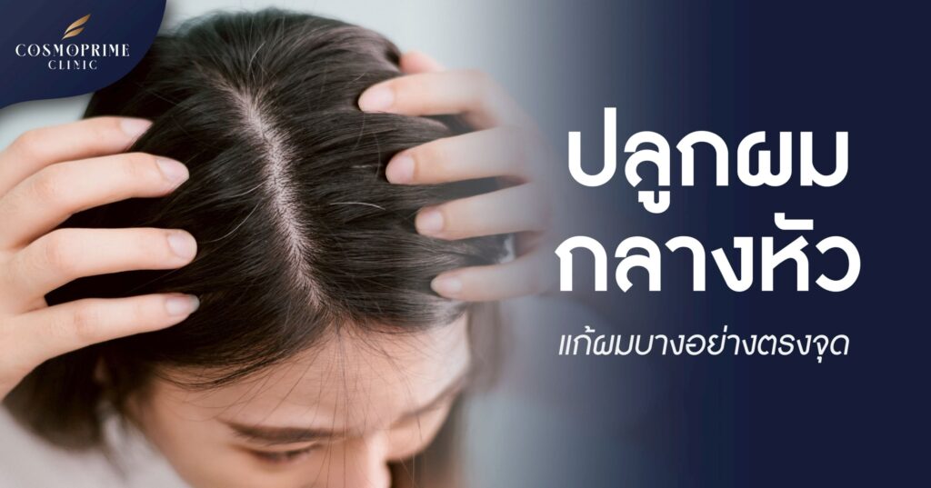 ปลูกผมกลางหัว