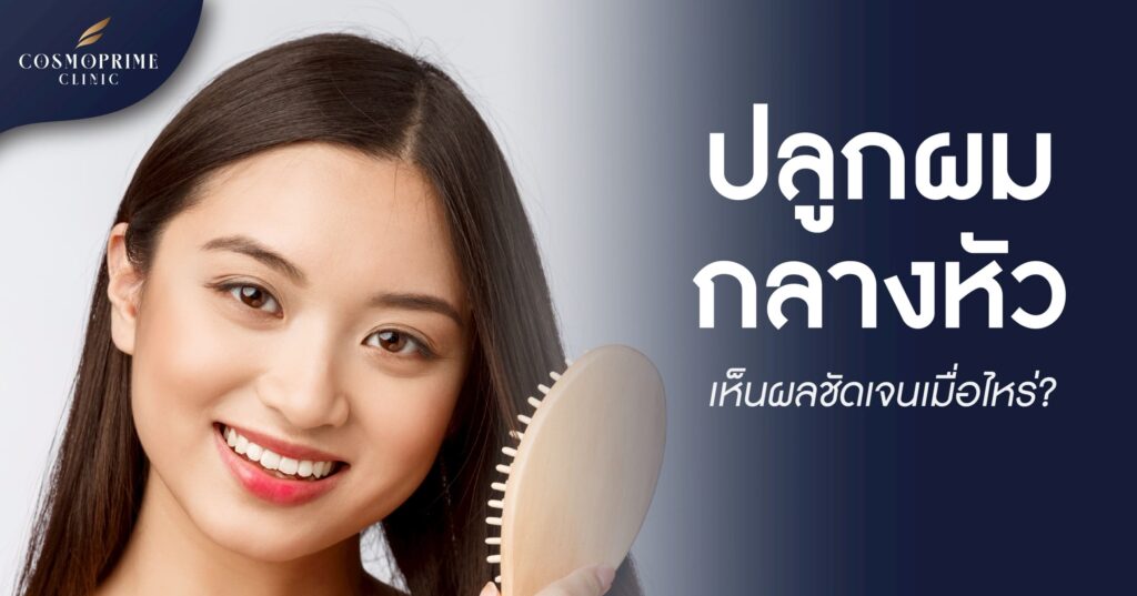 ปลูกผมกลางหัว เห็นผลชัดเจนเมื่อไหร่?