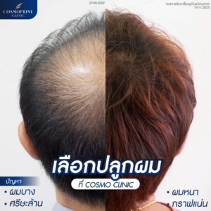 ปลูกผมกลางหัว