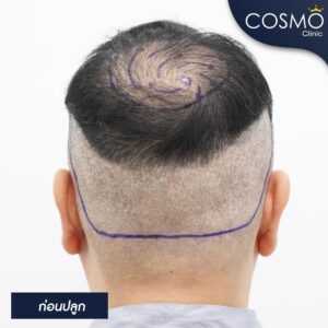 ผมบางกลางหัว ใช้อะไรดี