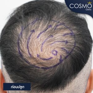 ผมบางกลางหัว เกิดจาก