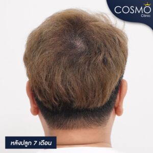 ผมกลางหัวบาง ผู้ชาย