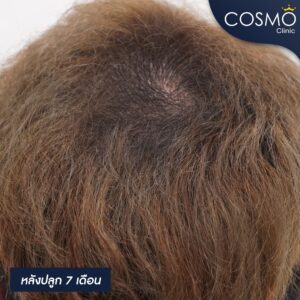 วิธีแก้ผมบาง ผู้ชาย