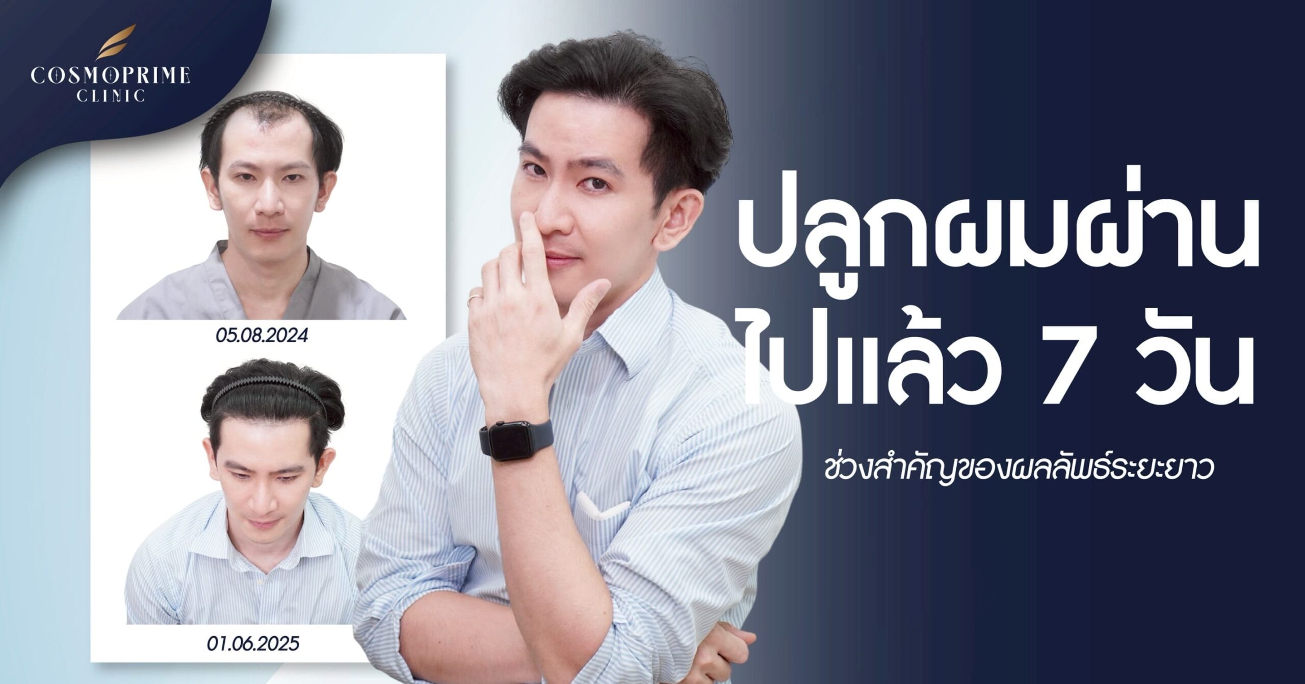 ปลูกผมผ่านไปแล้ว 7 วัน