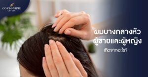 ผมบางกลางหัว ในผู้ชาย ผู้หญิง