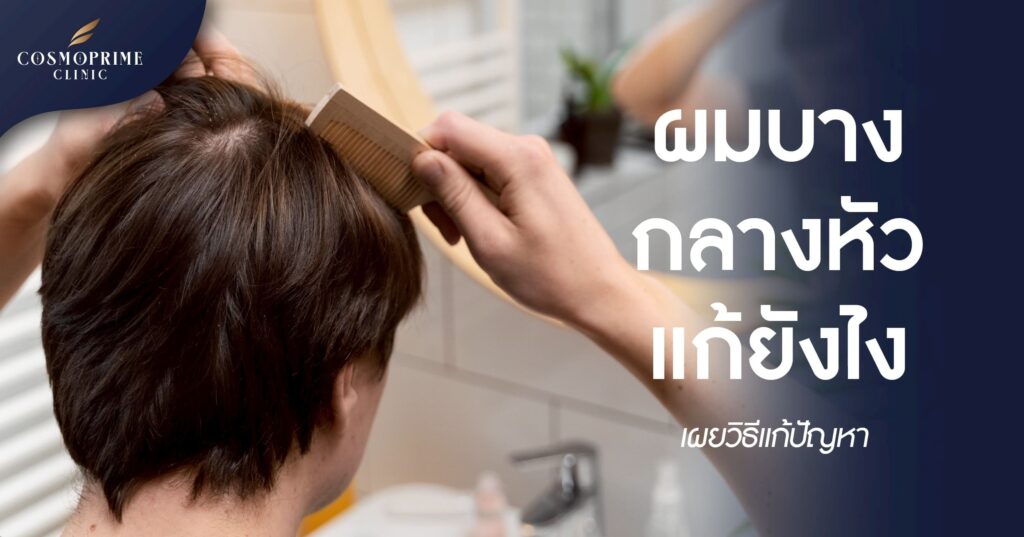 ผมบางกลางหัว