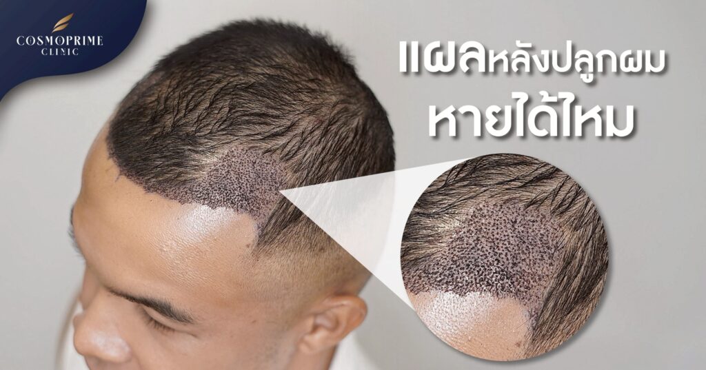 แผลหลังปลูกผม