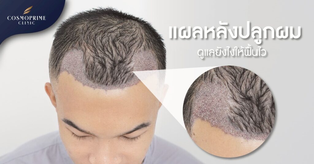 แผลหลังปลูกผม