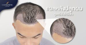 แผลหลังปลูกผม