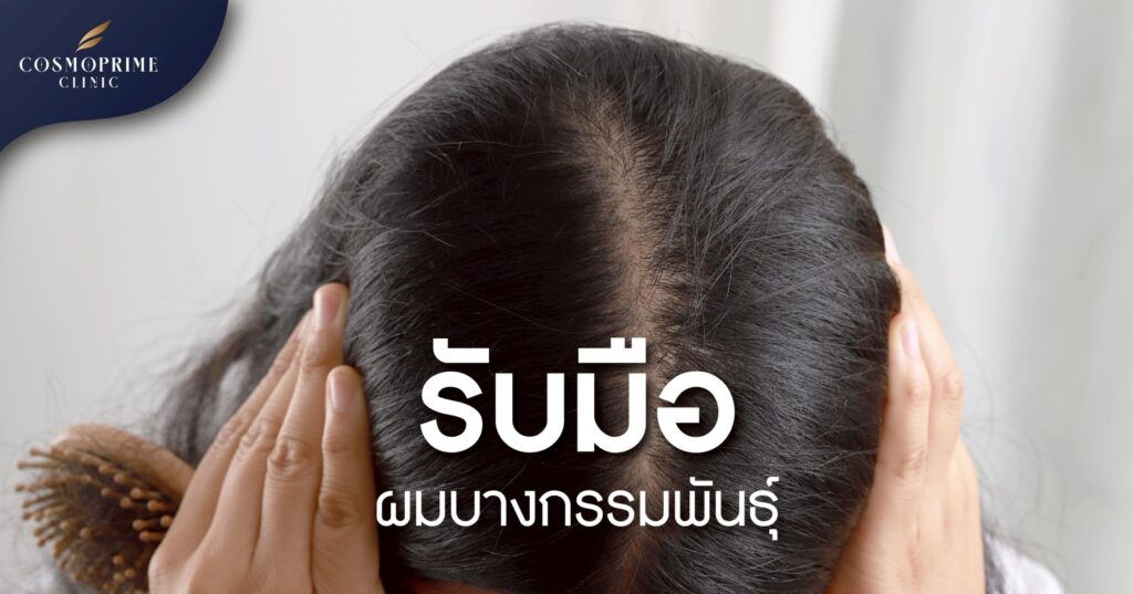 ผมบางกรรมพันธุ์