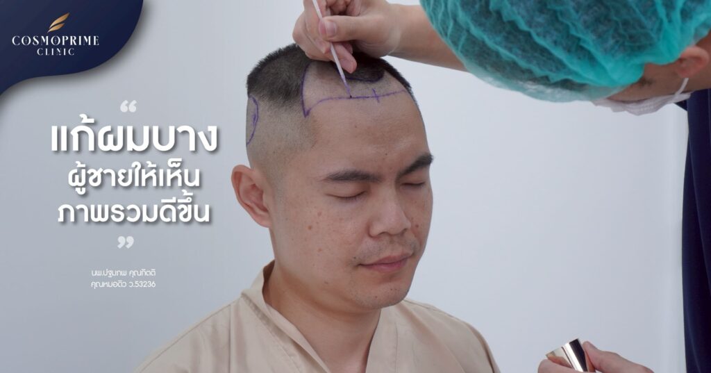 วิธีแก้ผมบาง ผู้ชาย