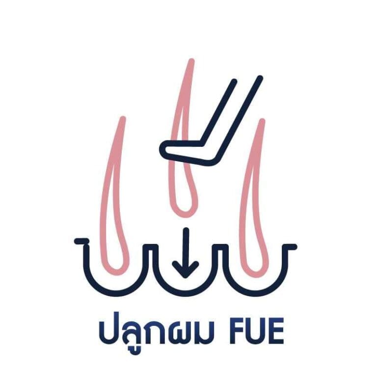ปลูกผม FUE