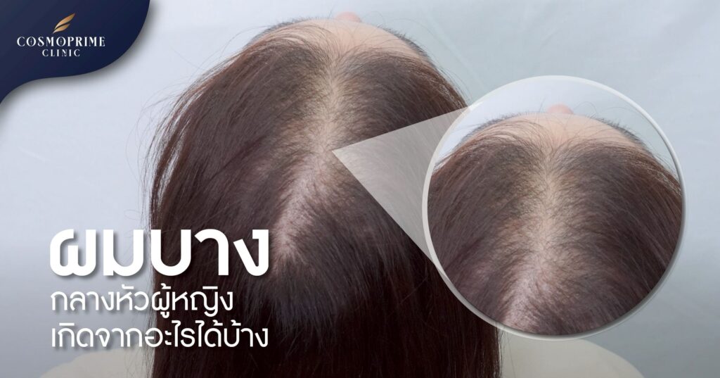 ผมบางกลางหัว