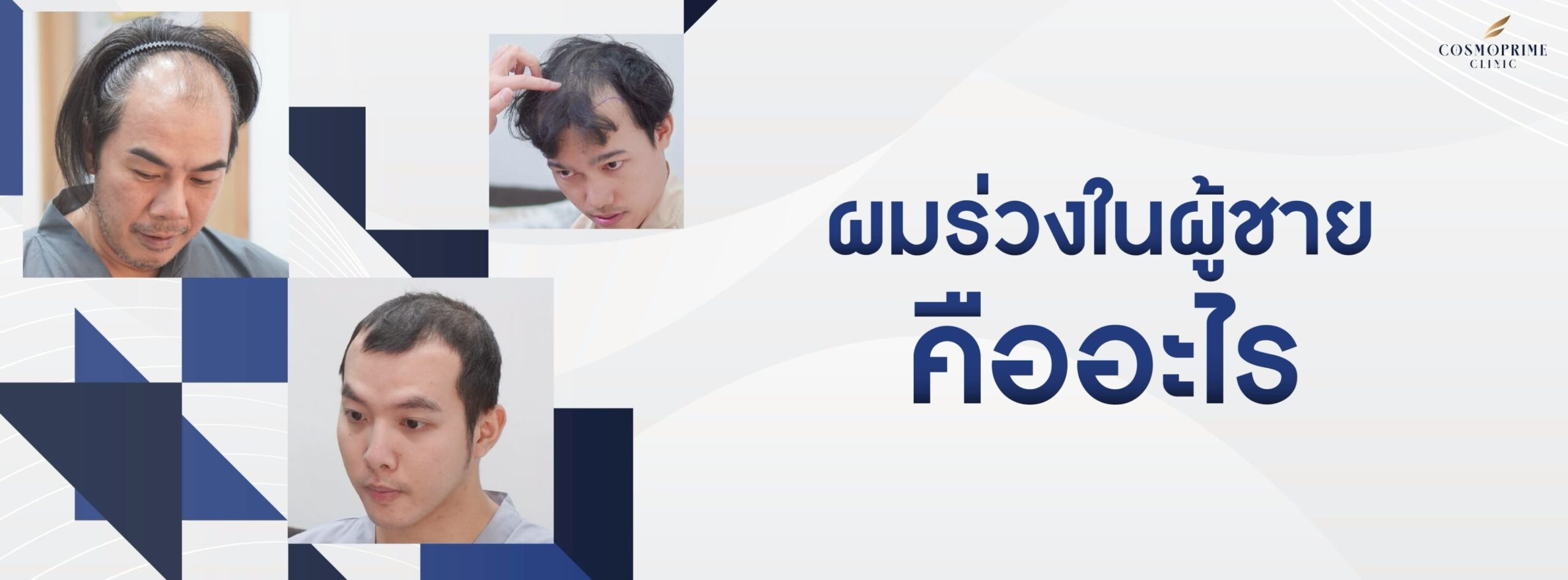 ผมร่วงในผู้ชาย